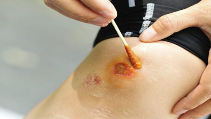 Mơ thấy bị ngã chảy máu nên đánh số mấy